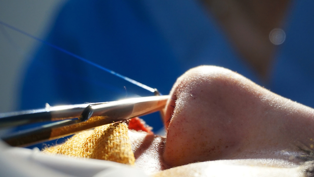 תקריב ניתוח אף מנתח מנתחים בריאות  (צילום: shutterstock)