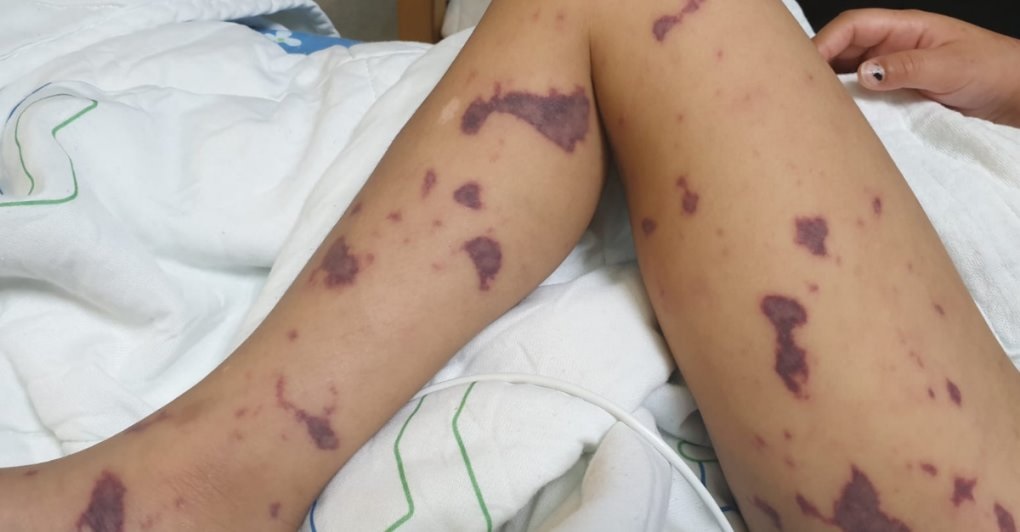 Тело девочки покрылось пурпурами. Фото: пресс-служба больницы "Меир"