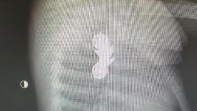 Значок командира взвода в пищеводе малыша. Рентгеновский снимок из больницы "Каплан"