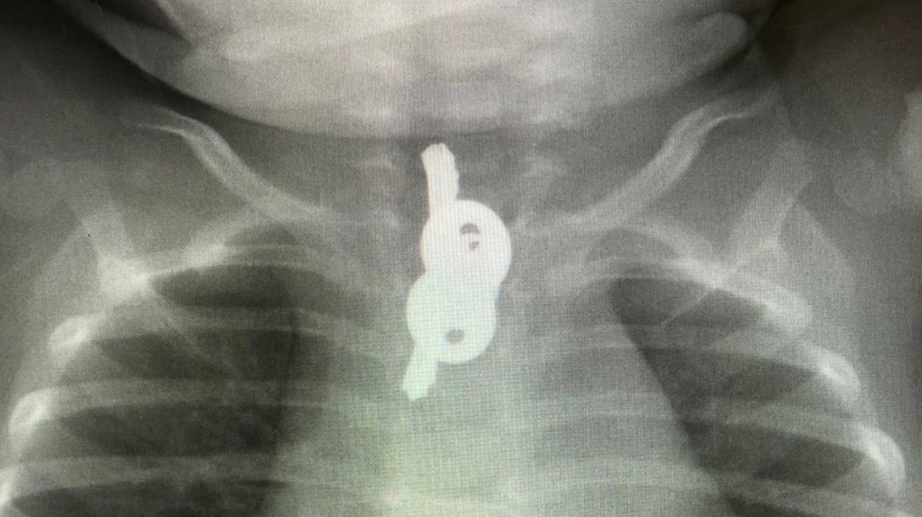 Рентгенограмма ребенка с проглоченными ключами. Предоставлено больницей "Шаарей-цедек"
