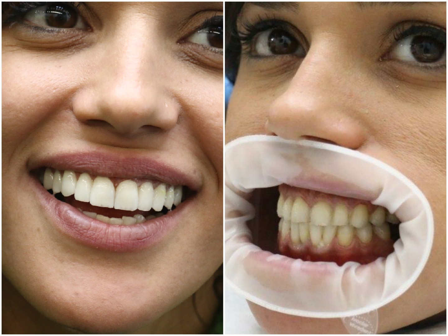 ציפוי שיניים בטורקיה (צילום: תומר בן יוסף)