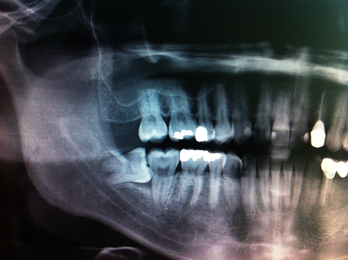 Рентгенограмма зубов. Фото: shutterstock