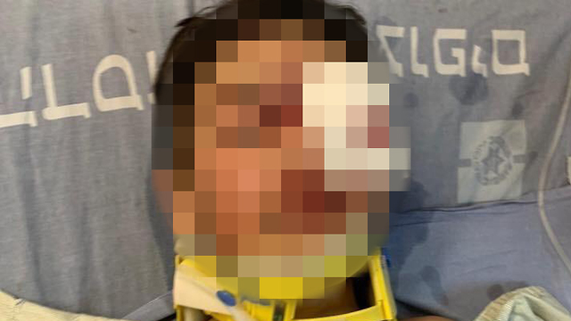 בן 9 מעיסאוויה פונה להדסה עם פגיעה קשה בפניו ובראשו ()