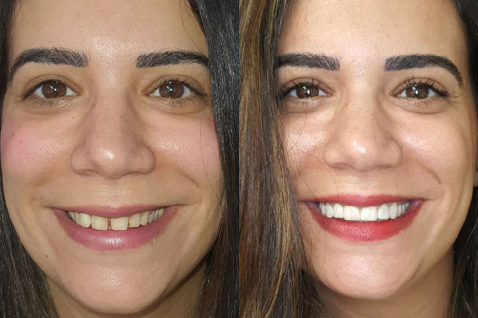 יש אנשים שמתביישים לחייך כי יש להם מרווחים בין השיניים, שיניים עקומות, שיניים בעלות גוון צהבהב, והטיפול הזה פשוט יכול להחזיר להם את החיוך לחיים (צילום: באדיבות מרפאת ד"ר דולב)