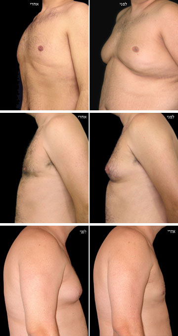 בניתוח שואבים רקמת שומן ועודף רקמת שד, ובמקרים קשים גם עודפי עור (באדיבות ד"ר נמרוד פרידמן, מנתח פלסטי)